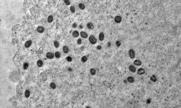 Rio Grande do Norte confirma três novos casos de Mpox; pacientes seguem em isolamento